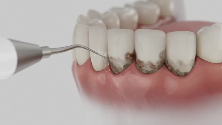 Trusted Wisdom Tooth Removal service in Moore, OK - Dentist Open Now
